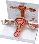 Female Uterus Anatomy Model showing common pathologies